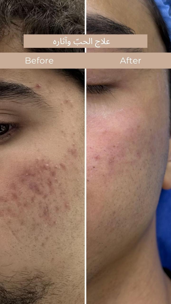 Acne treatment before and after result at Gala Clinics Amman