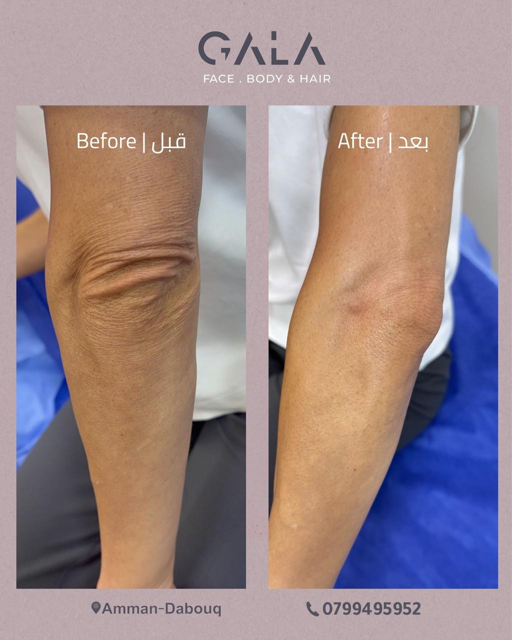 Arm skin tightening before and after at Gala Clinics Amman