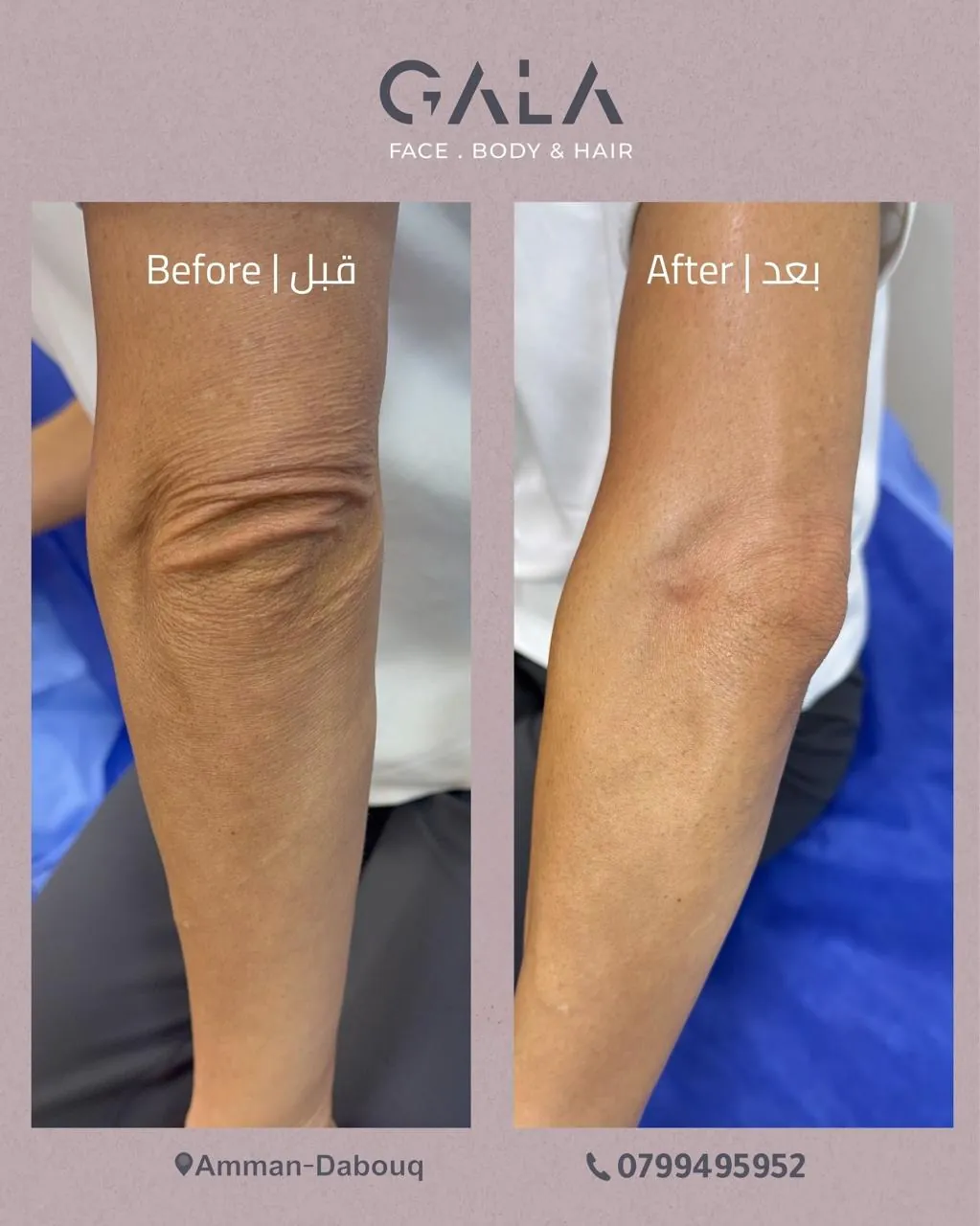 Arm skin tightening before and after at Gala Clinics Amman