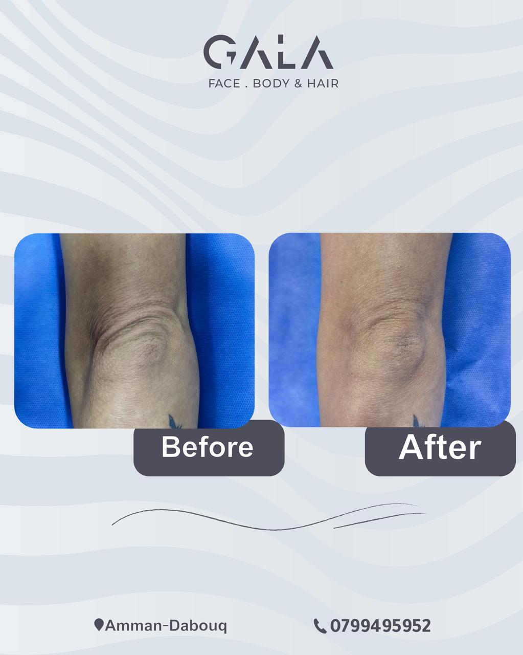 Body skin tightening before and after at Gala Clinics Amman
