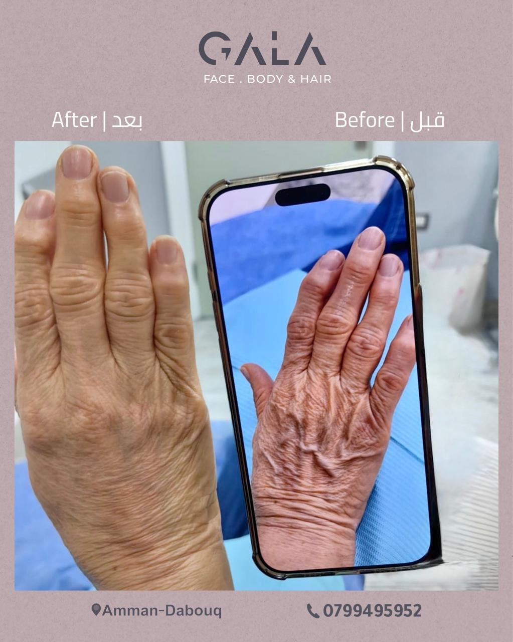 Hand rejuvenation skin booster before and after at Gala Clinics Amman