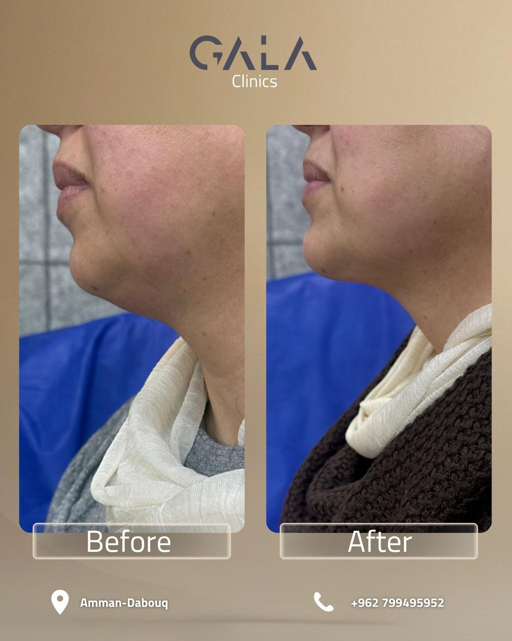 Jawline and chin contouring before and after at Gala Clinics Amman