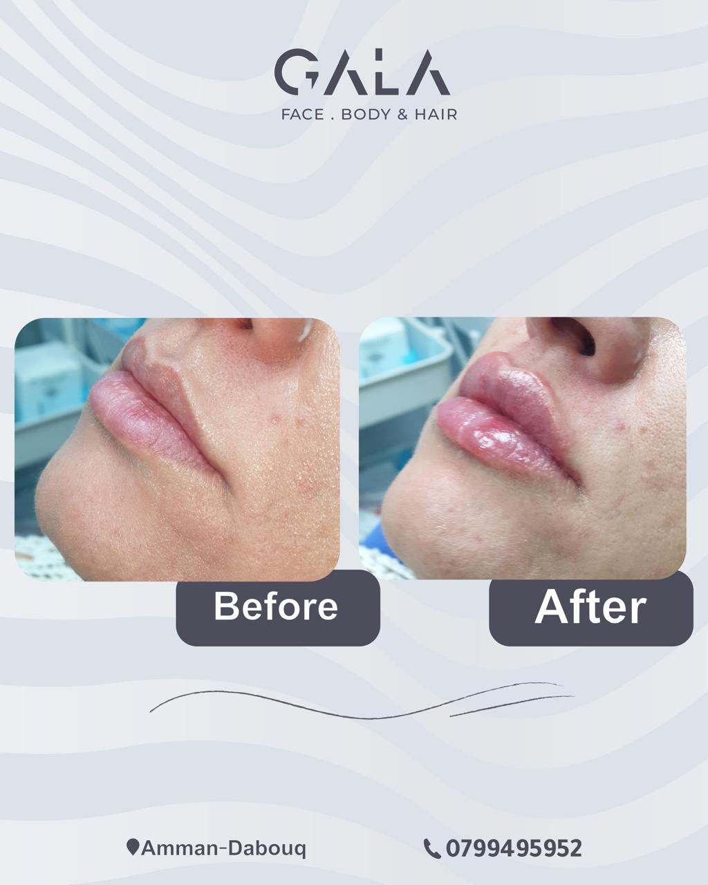 Natural lip filler before and after result at Gala Clinics Amman
