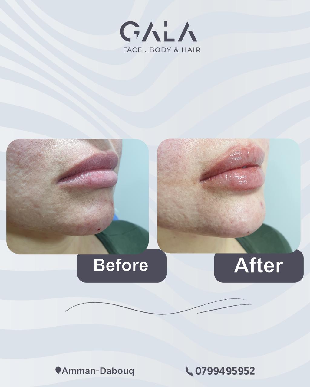 Natural lip enhancement before and after at Gala Clinics Amman