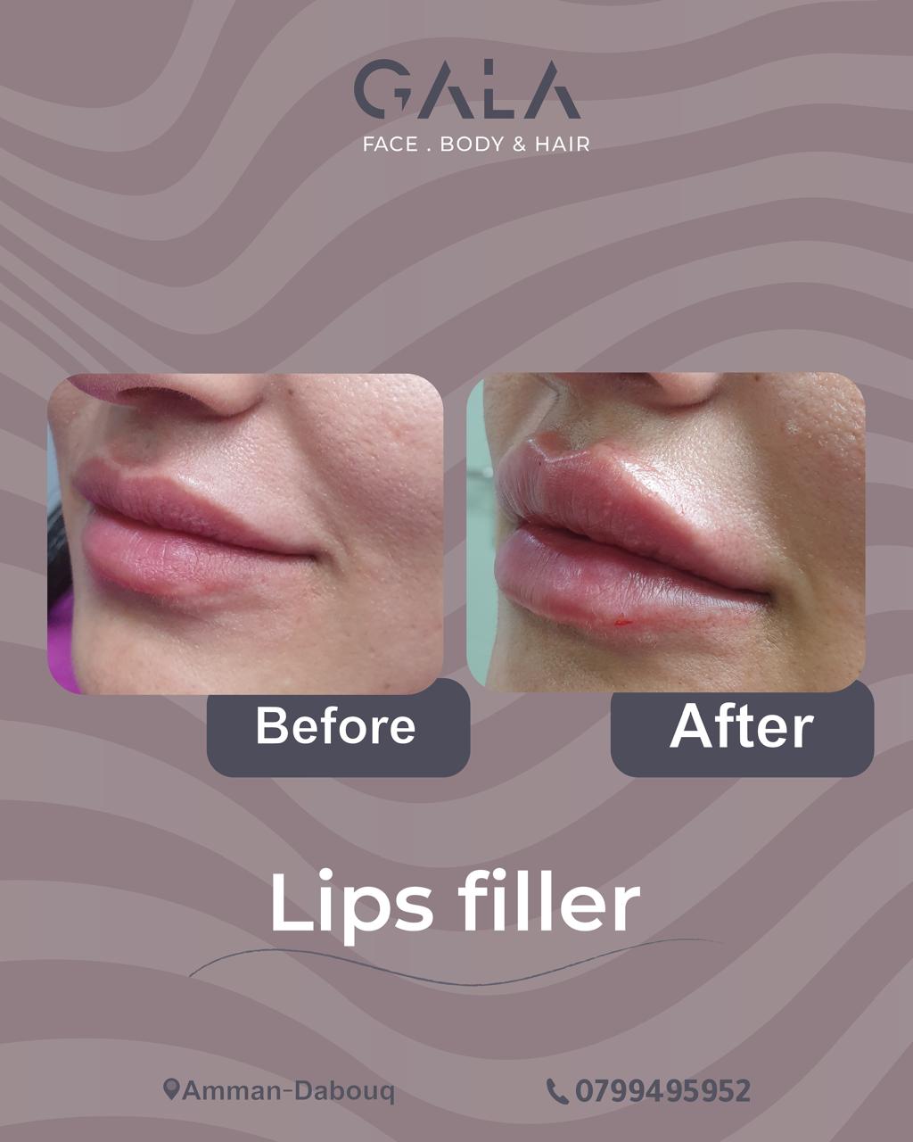 Lip filler before and after result at Gala Clinics Amman