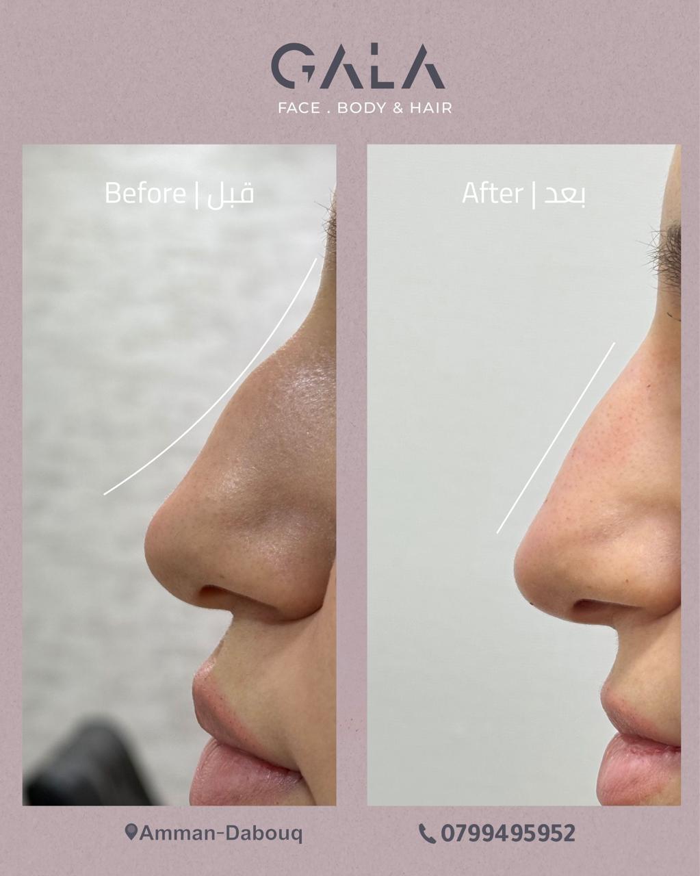 Non-surgical nose filler before and after at Gala Clinics Amman