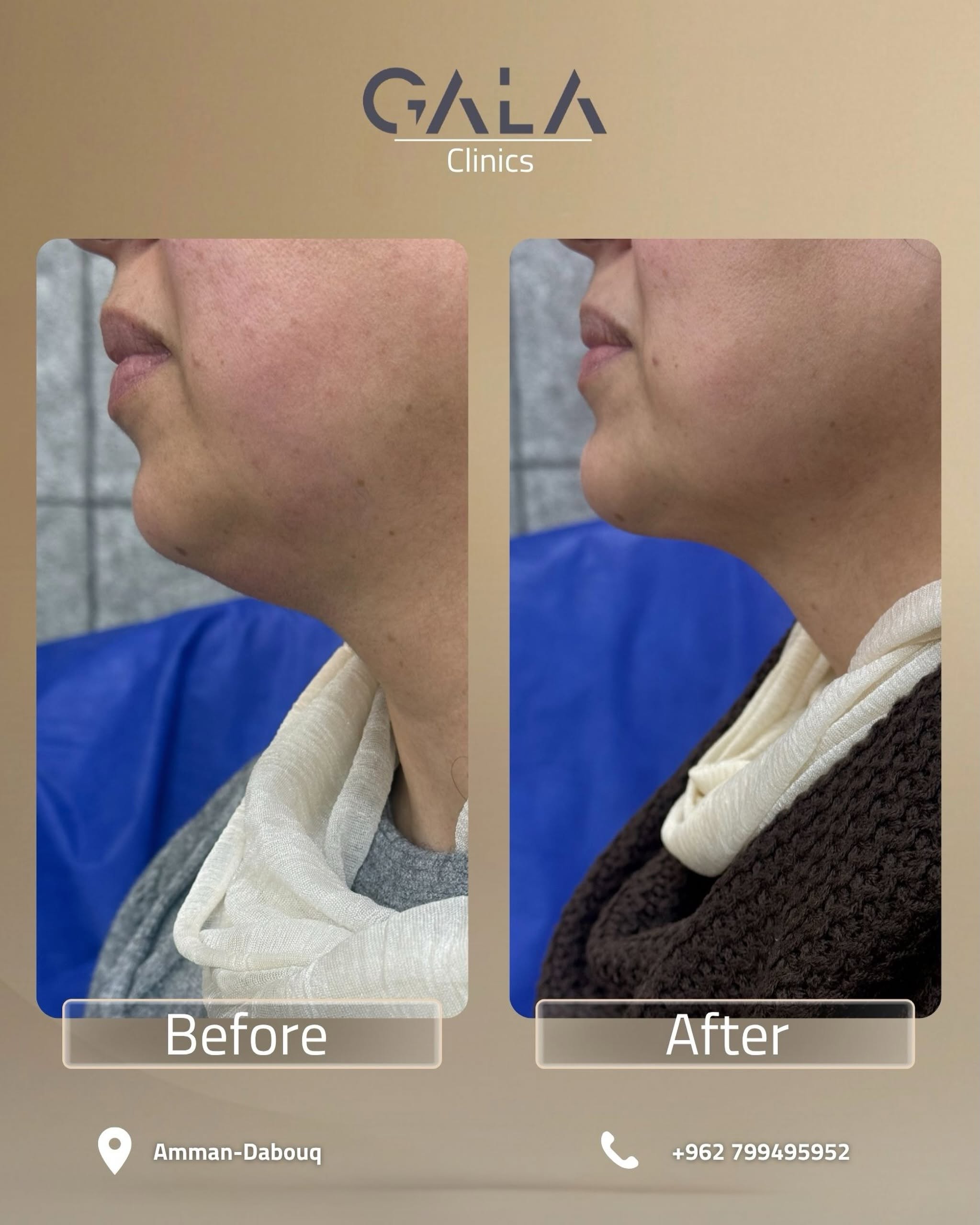 Jawline before and after