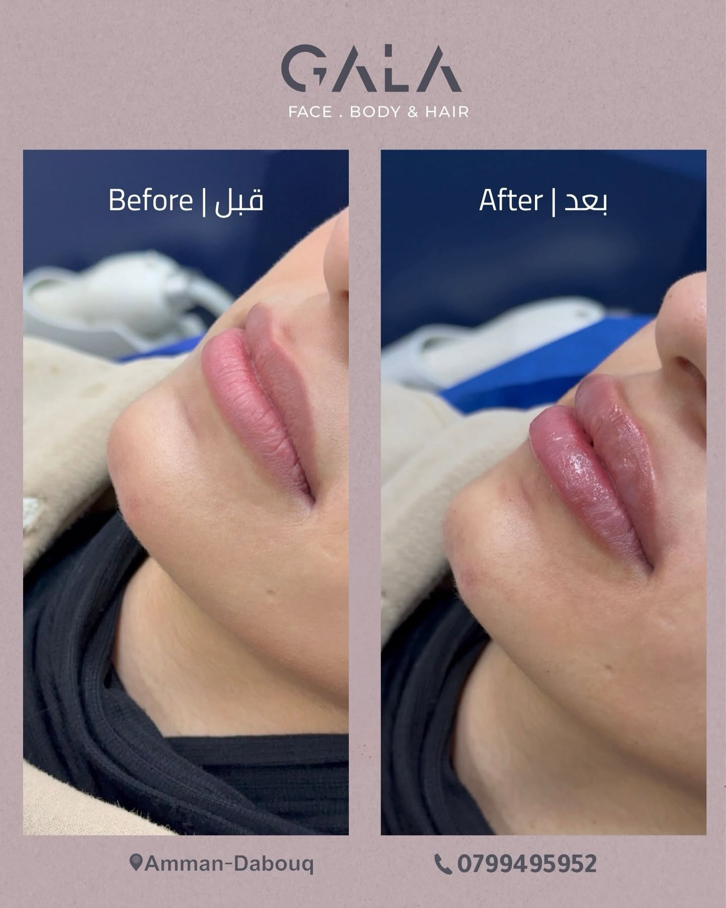 Lip filler before and after