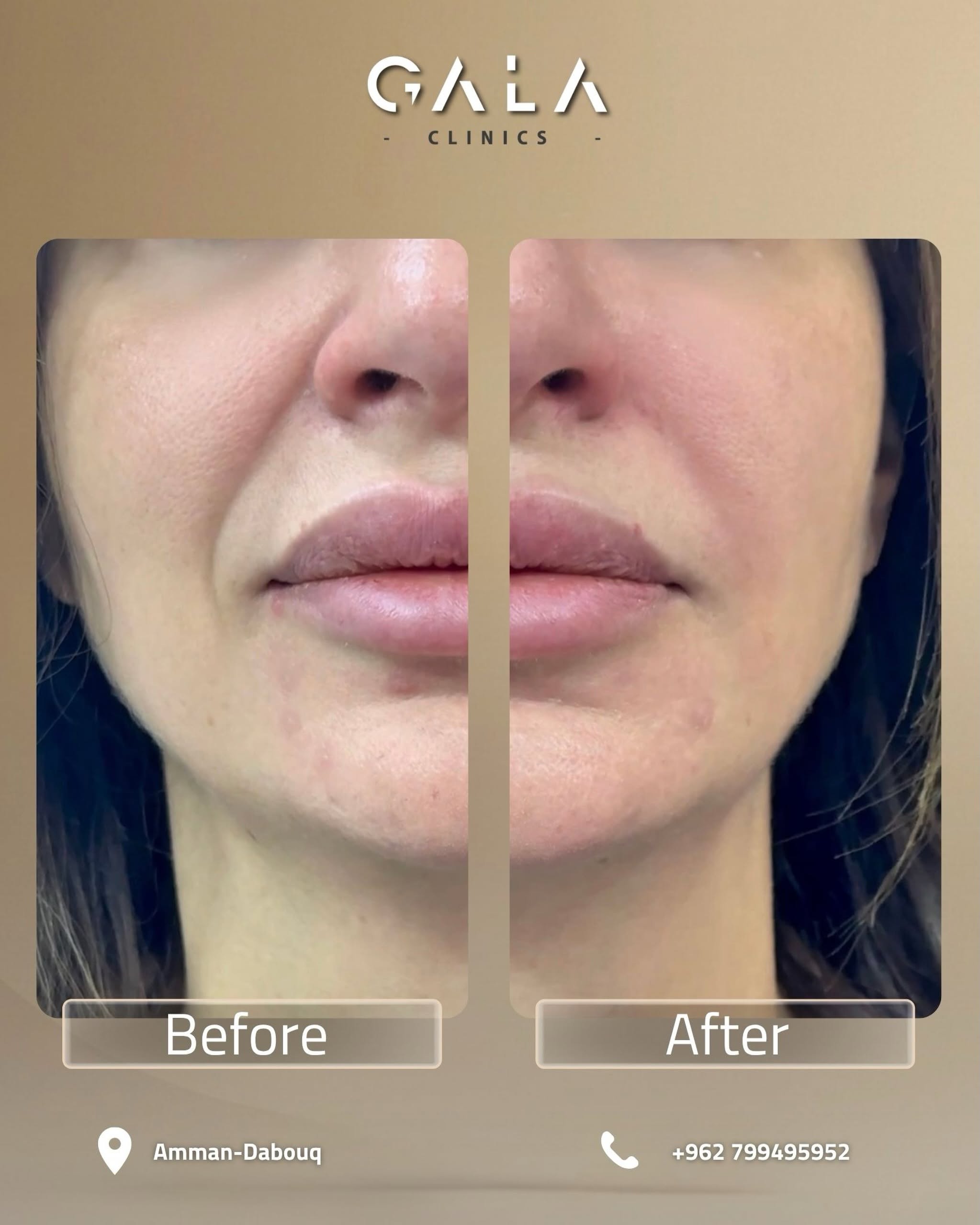 Lip enhancement before and after