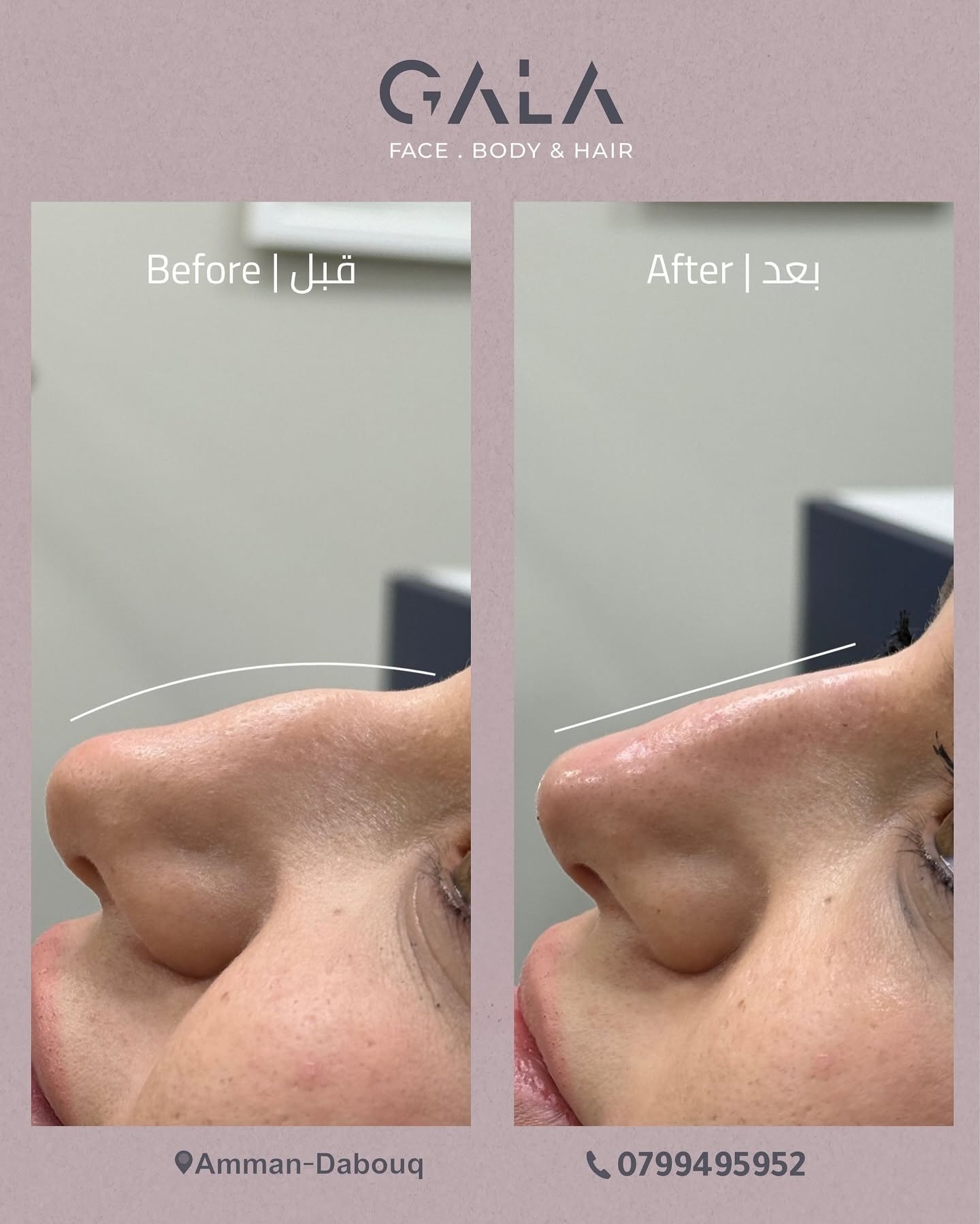 Nose profile before and after