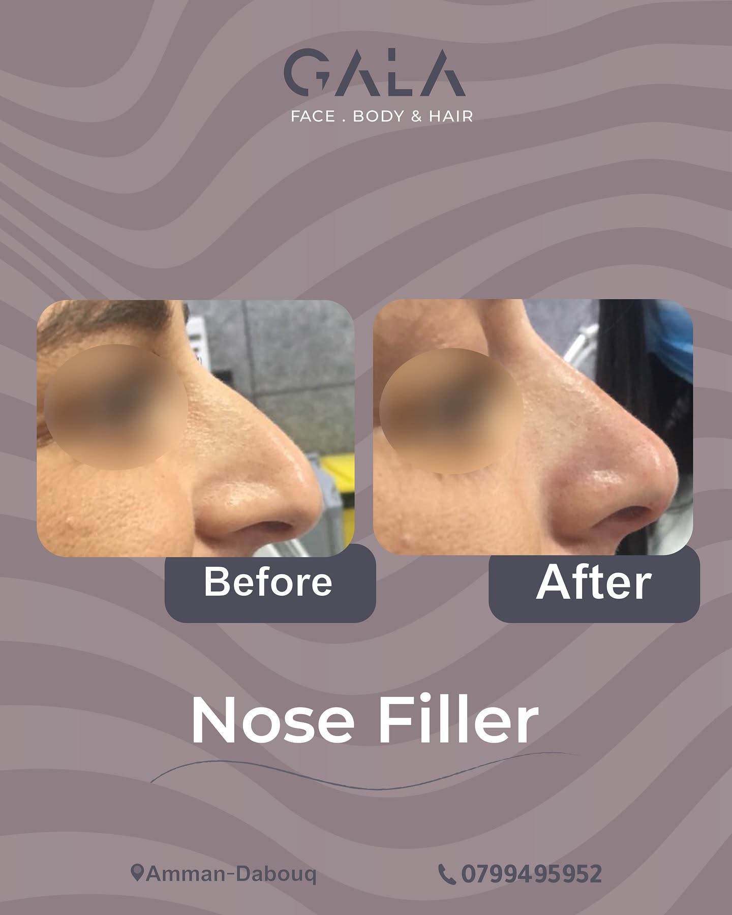 Nose filler before and after