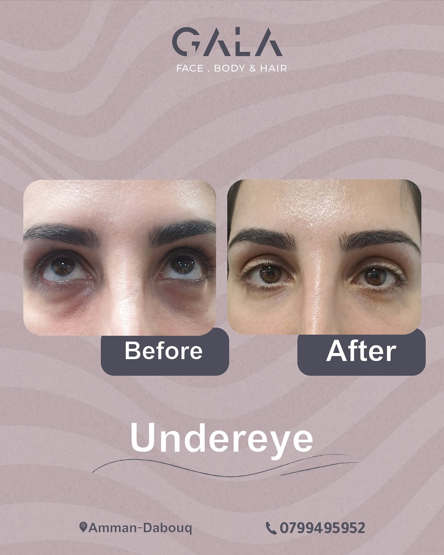 Under-eye before and after
